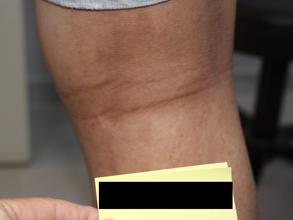 CASE 01 치료 후