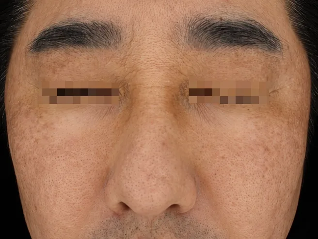 CASE 01 치료 후