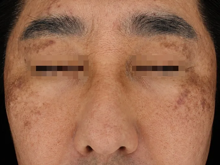 CASE 01 치료 전