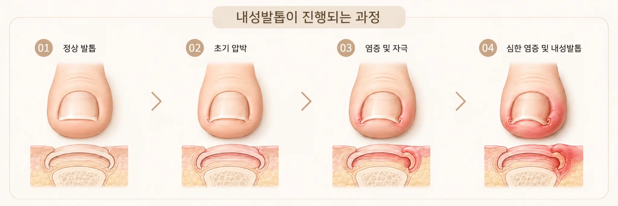 내성발톱은 왜 관리가 중요할까요?