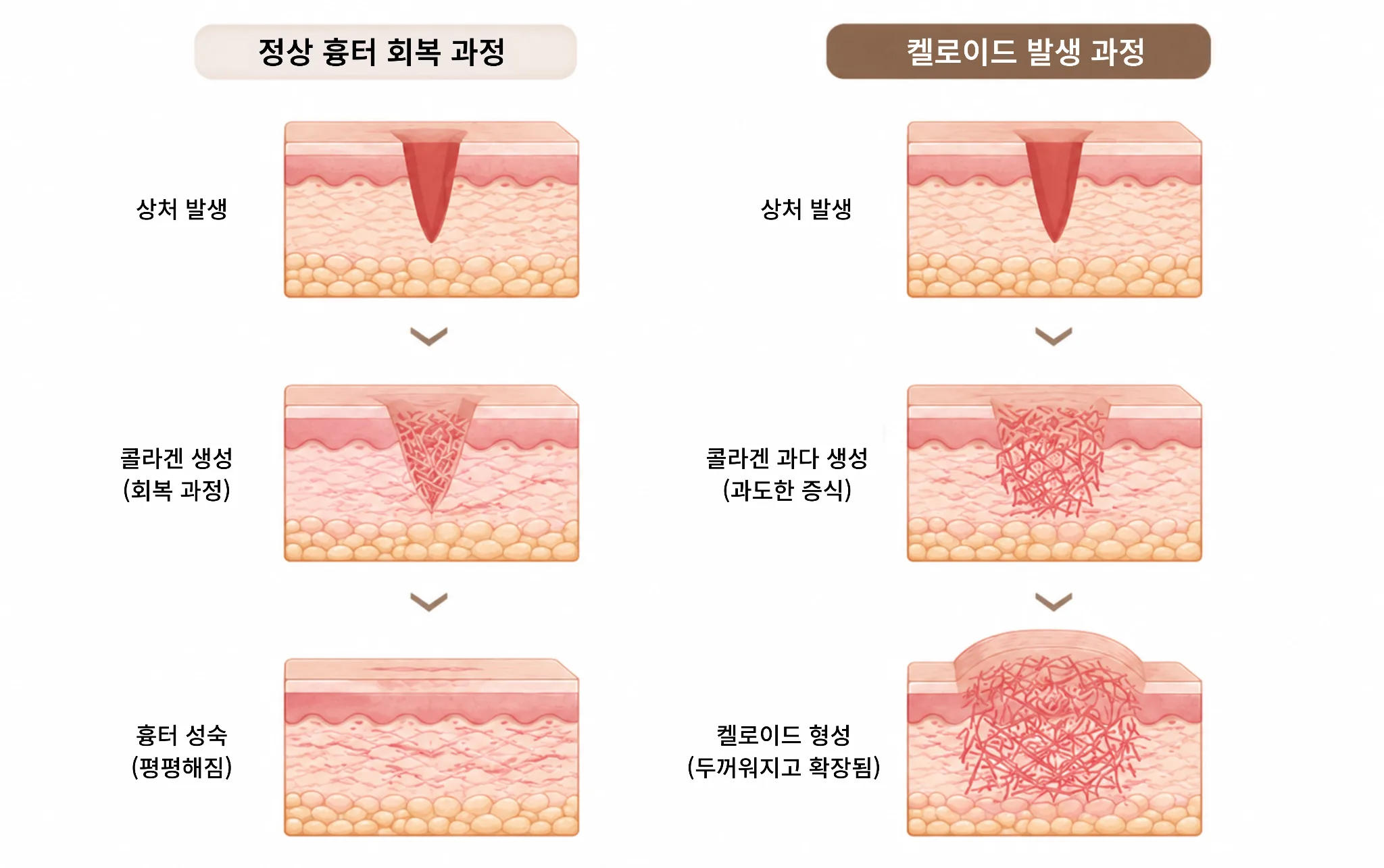 켈로이드는 왜 생길까요?