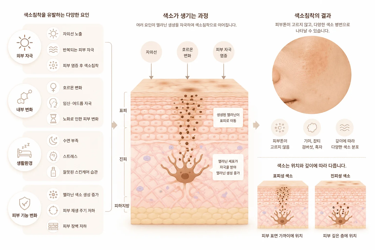 왜 색소침착이 생길까요?